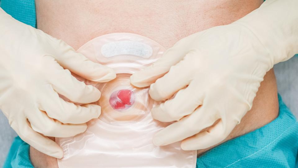 Symposium : prise en charge du patient stomisé 