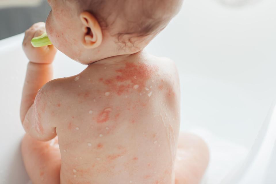 Focus sur la varicelle, avec le Dr Gilis