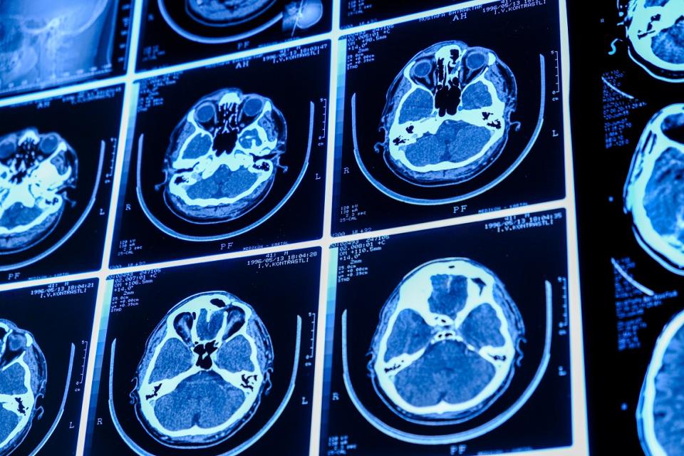 Neuroradiologie et radiologie interventionnelle